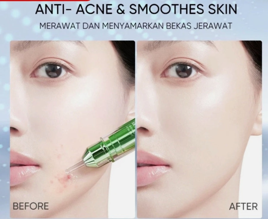 Skintific 3X Acid Intensive Acne Spot